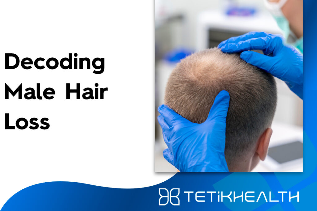 Decoding Male Hair Loss Exploring Causes And Solutions With