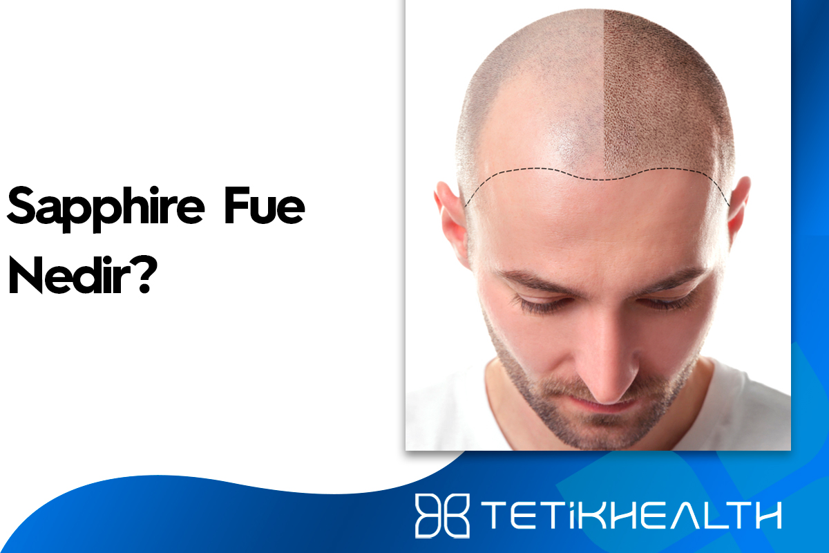 Sapphire FUE Nedir? Saç Ekimi Teknolojisinde Bir Devrim!