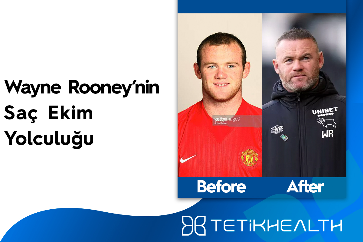 Wayne Rooney’nin saç ekimi yolculuğu
