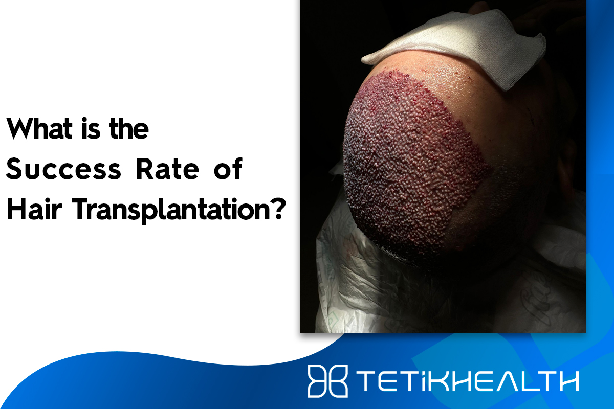 What is the Success Rate of Hair Transplantation?