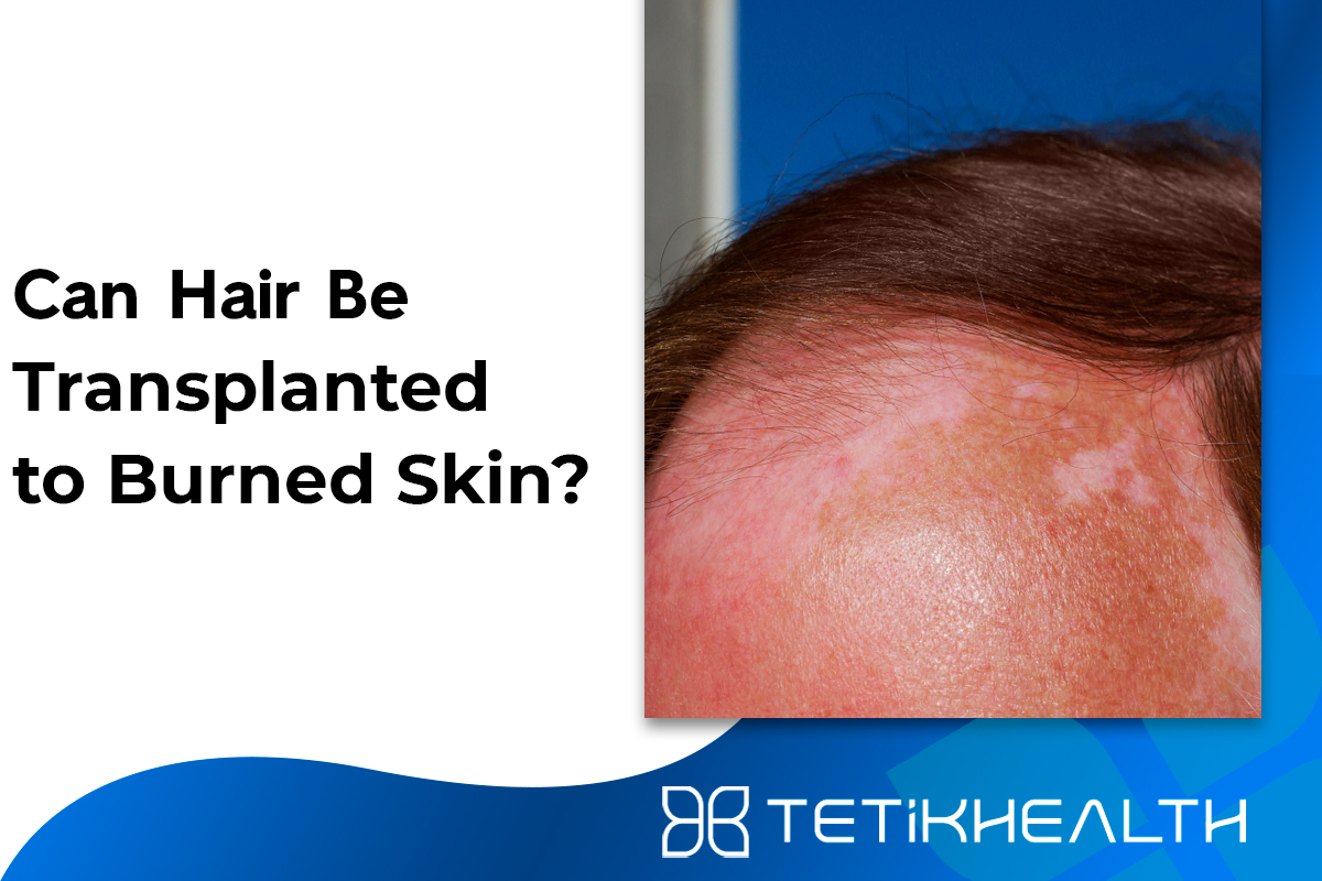 Can Hair Be Transplanted to Burned Skin?