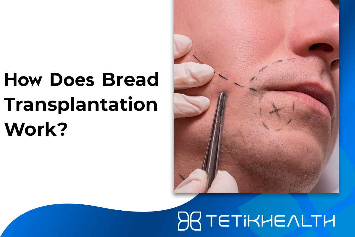 How Does Beard Transplantation Work?