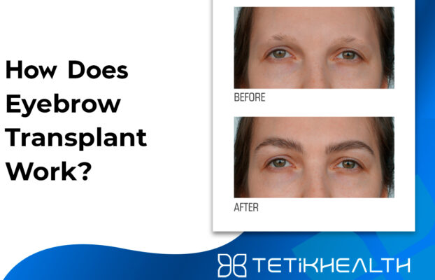 How Does Eyebrow Transplant Work?