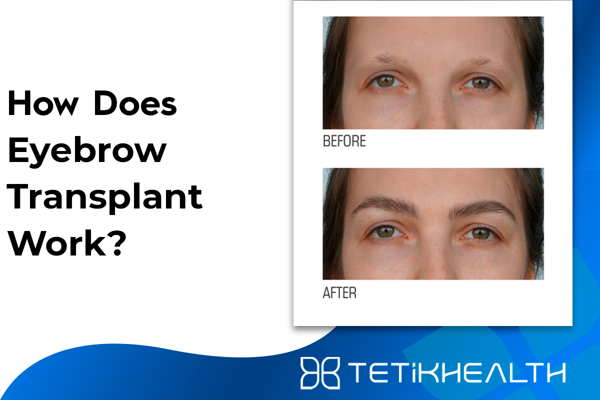 How Does Eyebrow Transplant Work?